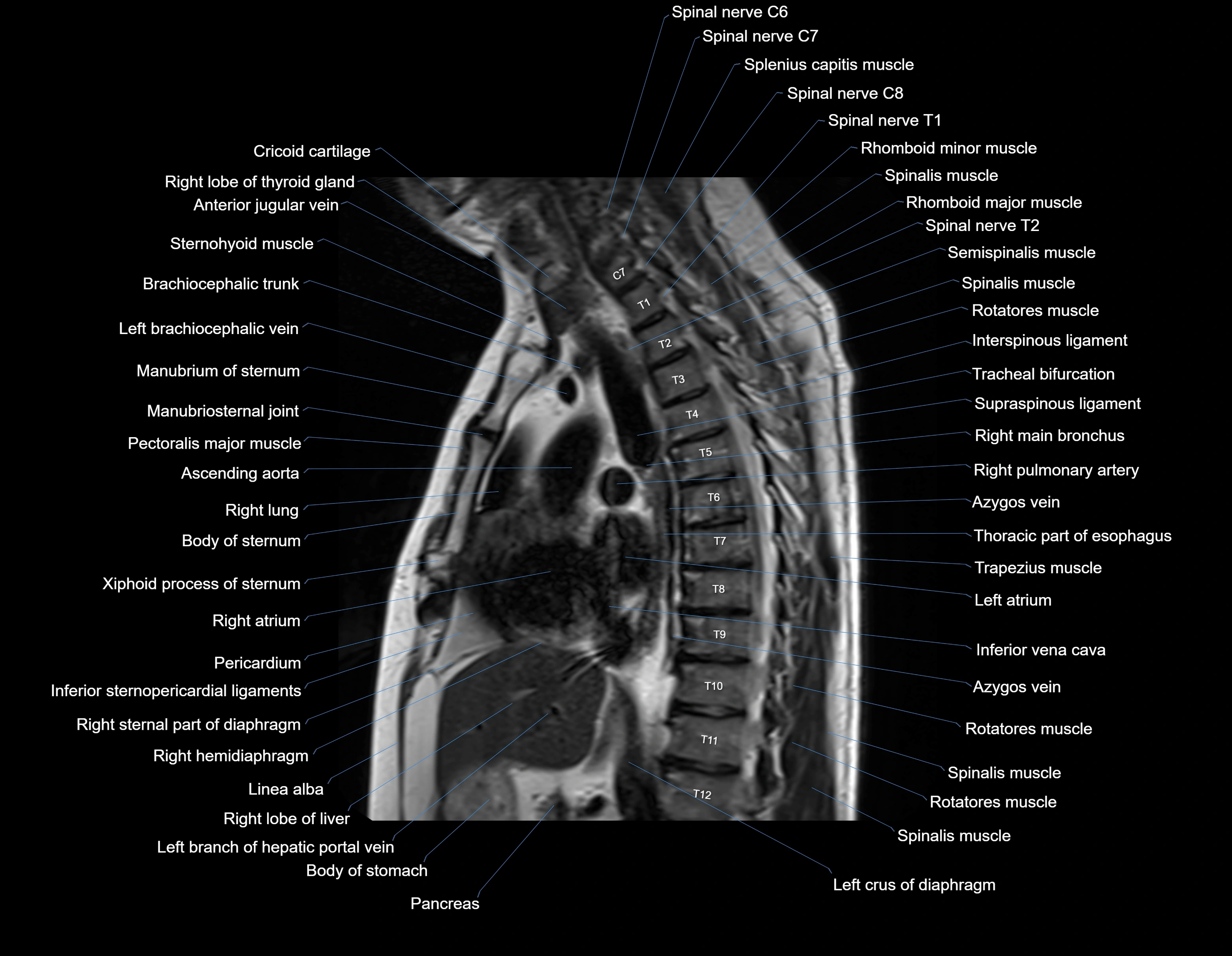 MRI chest (thorax) sagittal labelled cross sectional anatomy 3T radiology image-img-00001-00019.webp